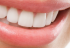 Teeth Whitening Procedure
